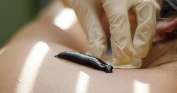 Leech Therapy (Hirudotherapy) – $35 per leech